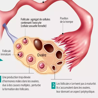 Syndrome Polycystic d'ovaire (PCOS)