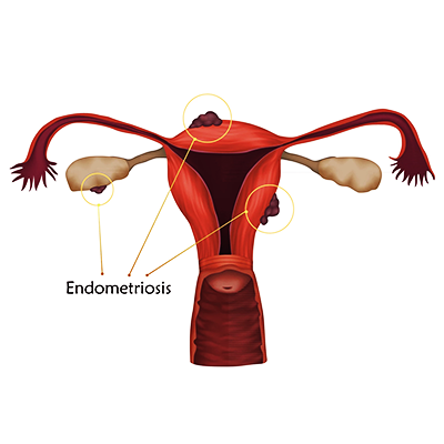 Endométriose