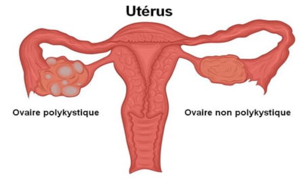 Syndrome des ovaires polykystiques